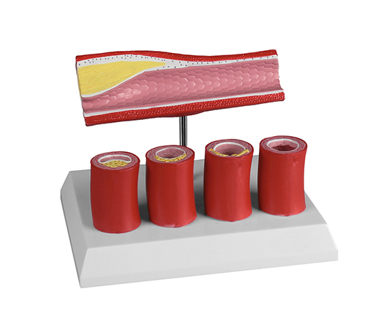 動脈硬化モデル